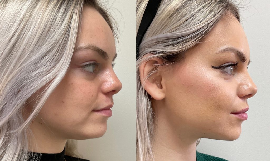 Liquid Face Lift