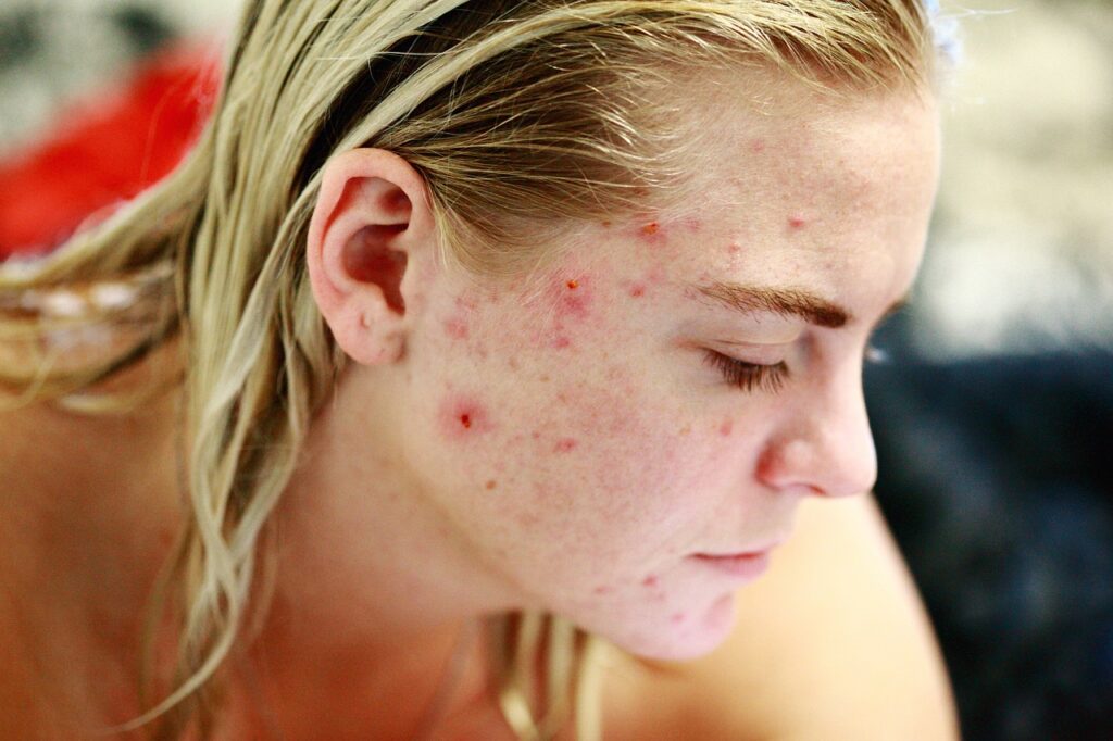 Microneedling for acne