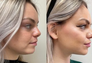 Liquid Face Lift